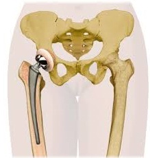 endo-tr1